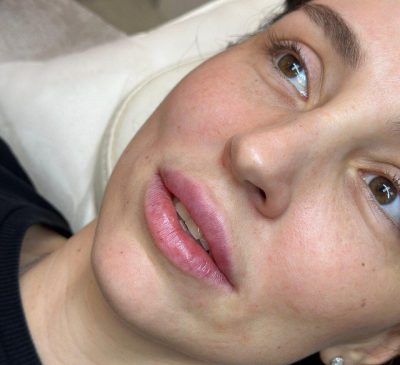 Lippen einer Patientin nach der Hyaluron-Behandlung